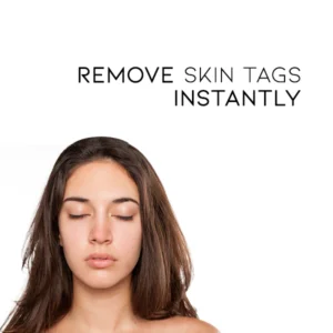 WipeOff Tags & Moles Remover - Image 3