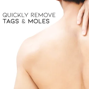 WipeOff Tags & Moles Remover - Image 4