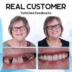 Premium Custom Silicone Denture Set - Image 7