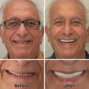Custom Functional Denture Kits - Image 4