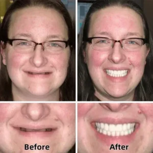 Custom Functional Denture Kits - Image 2