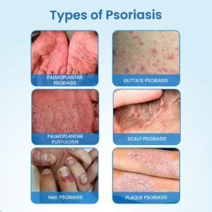 MagnesiumHerb Psoriasis Relief Cream - Image 8