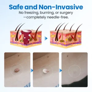 TagGone Wart Removal Cream - Image 4