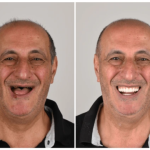 3D Dentures - Image 2