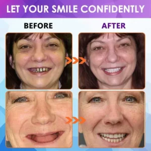 Advanced Customized Full Denture Set - Image 10