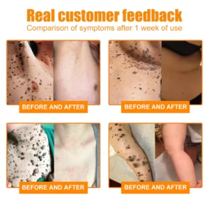 Bee Venom Mole and Wart Treatment Spray - Image 3