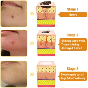 Bee Venom Mole and Wart Treatment Spray - Image 8