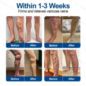 𝐕𝐞𝐢𝐧𝐓𝐚𝐫𝐠𝐞𝐭 𝐌𝐢𝐜𝐫𝐨𝐧𝐞𝐞𝐝𝐥𝐞 𝐏𝐚𝐭𝐜𝐡 - Image 2