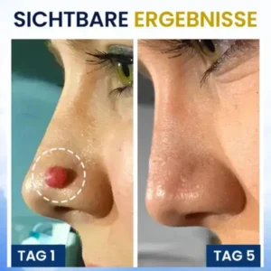 Hautanhängsel-Kryo-Behandlungsspray - Image 7