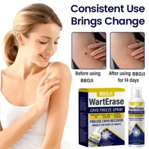 WartErase Cryo Freeze Spray - Image 7