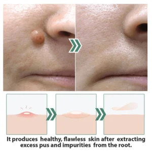 ClearDerm Skin Tag Removal Patch - Image 4