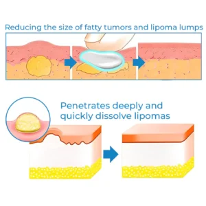 Lipoma Treatment Ointment - Image 3