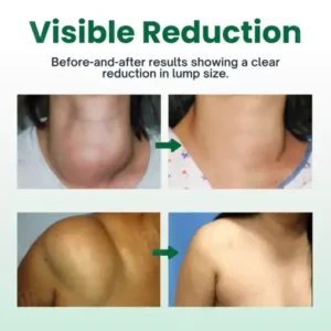 Knot-X Lipoma Dissolve Cream - Image 2