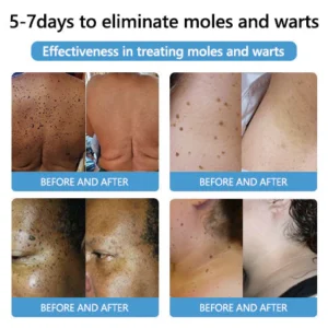 PRO Bee Venom Mole and Wart Treatment Cream - Image 4