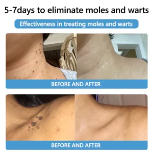 PRO Bee Venom Mole and Wart Treatment Cream - Image 5