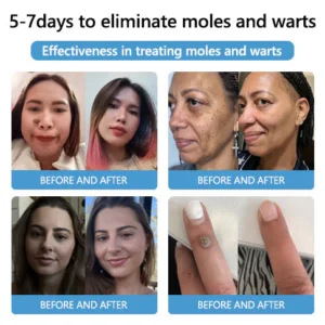PRO Bee Venom Mole and Wart Treatment Cream - Image 6