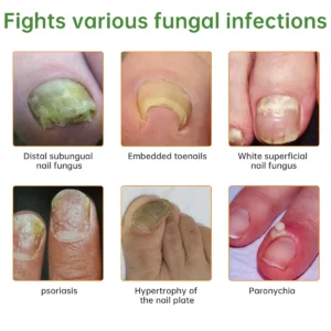 Bee Venom Nail Fungus Treatment Liquid - Image 2