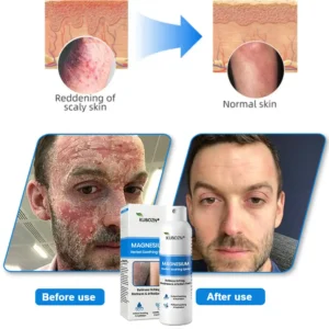 Magnesium Herbal Psoriasis Spray - Image 3