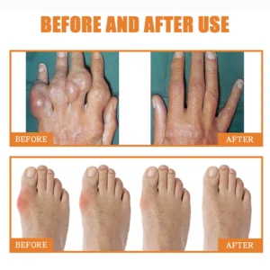 Bee Venom Vitamin D Arthritis Joint Pain Relief Spray - Image 4