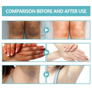 EELHOE-Acanthosis Nigricans Therapy Cream - Image 5