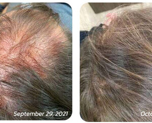 Scalp Folliculitis Therapy Oil - Image 6