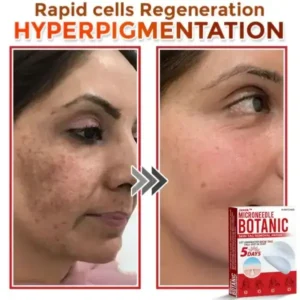 Removal Patch: Gentle Microneedle Patches for Skin Tag & Mole Removal - Image 6