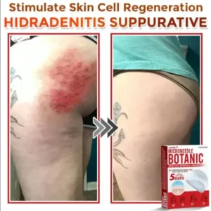 Removal Patch: Gentle Microneedle Patches for Skin Tag & Mole Removal - Image 9