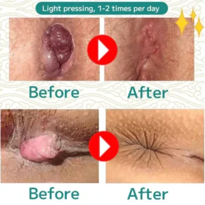 Natural Herbal Strength Hemorrhoid Capsules - Image 4
