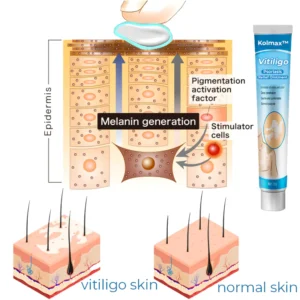 Vitiligo Soothing Ointment - Image 6