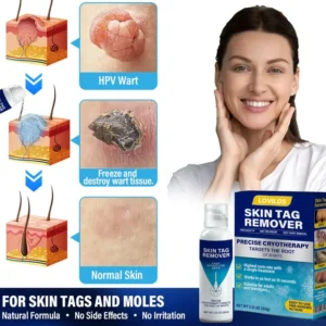 Cryo Treatment Spray Effortlessly remove skin tags and warts-no pain - Image 2