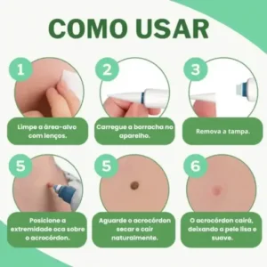 – Skin Wart & Skin Tag Removal Kit - Image 4