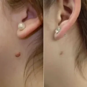 Skin Wart & Skin Tag Removal Kit - Image 3