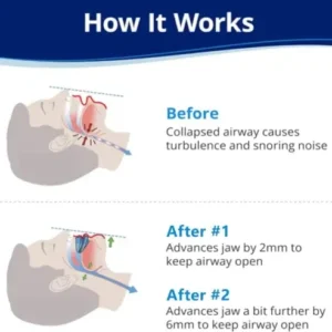 Anti-Snoring Mouthpiece - Image 2
