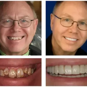 Custom-Fit Functional Dentures Smile with Confidence - Image 6