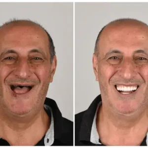 Custom-Fit Functional Dentures Smile with Confidence - Image 7