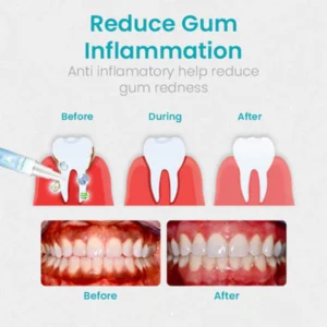 Gum Shield Therapy Gel - Image 6