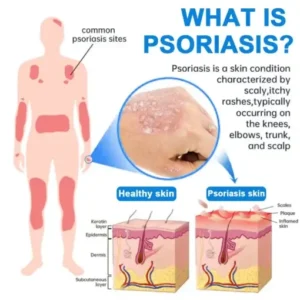 QIAWI Magnesium Herbal Psoriasis Spray - Image 3