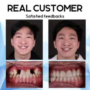 Premium Custom Silicone Denture Set - Image 15