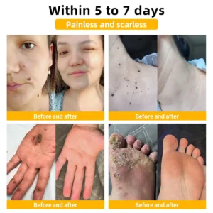 𝐁𝐞𝐞 𝐕𝐞𝐧𝐨𝐦 𝐌𝐨𝐥𝐞 𝐚𝐧𝐝 𝐖𝐚𝐫𝐭 𝐓𝐫𝐞𝐚𝐭𝐦𝐞𝐧𝐭 𝐂𝐫𝐞𝐚𝐦 - Image 2
