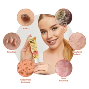 𝐁𝐞𝐞 𝐕𝐞𝐧𝐨𝐦 𝐌𝐨𝐥𝐞 𝐚𝐧𝐝 𝐖𝐚𝐫𝐭 𝐓𝐫𝐞𝐚𝐭𝐦𝐞𝐧𝐭 𝐂𝐫𝐞𝐚𝐦 - Image 7