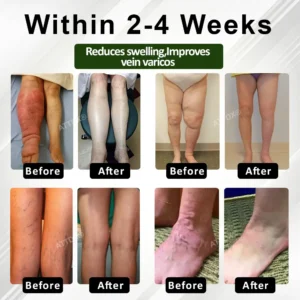 FluidEase Leg Therapy Edema Cream - Image 3