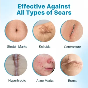 Silicone Anti-Scar Cream - Image 2