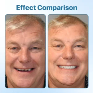 UltraComfort Silicone Denture Kit - Image 7