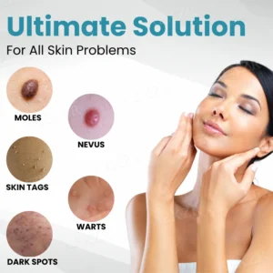 PRO Non-Invasive Mole and Wart Removal Laser Pen - Image 7