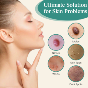 LumeSkin Mole and Wart Instant Removal Laser Pen ACE 4 - Image 3