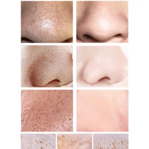 Facial Essence Blackhead Removal Kit - Image 6