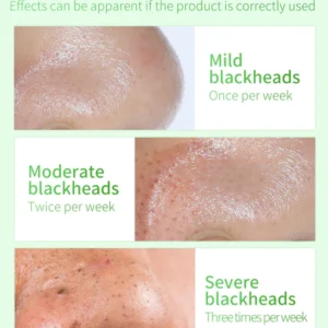 Facial Essence Blackhead Removal Kit - Image 7