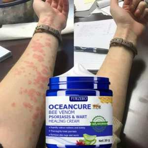 OceanCure Bee Venom Psoriasis & Wart Healing Cream - Image 5