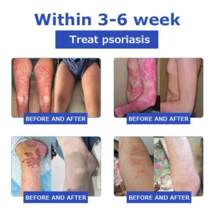 OceanCure Bee Venom Psoriasis & Wart Healing Cream - Image 8