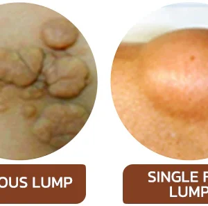 Lumpless Lipoma Treatment Cream - Image 2